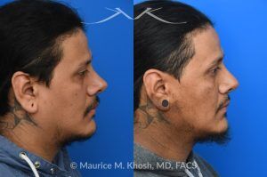 Photo of a patient before and after a procedure. Revision rhinoplasty and repair of nasal vestibular stenosis 1 - This patient previously sustained a nasal fracture that was treated with rhinoplasty. Unfortunately, the surgery did not resolve his breathing obstruction. The nasal bridge had been excessively lowered, creating a “ski-slope” profile, and the cartilaginous dorsum remained deviated to the left. During his revision rhinoplasty, the persistently deviated caudal septum was reconstructed with a strut graft, and the dorsal alignment and height were restored using a right sided spreader graft.  