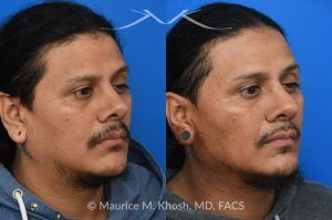 Photo of a patient before and after a procedure. Revision rhinoplasty and repair of nasal vestibular stenosis 1 - This patient previously sustained a nasal fracture that was treated with rhinoplasty. Unfortunately, the surgery did not resolve his breathing obstruction. The nasal bridge had been excessively lowered, creating a “ski-slope” profile, and the cartilaginous dorsum remained deviated to the left. During his revision rhinoplasty, the persistently deviated caudal septum was reconstructed with a strut graft, and the dorsal alignment and height were restored using a right sided spreader graft.  