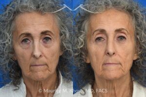 Photo of a patient before and after a procedure. Revision rhinoplasty with lower blepharoplasty 1 - This patient underwent revision rhinoplasty to improve nasal airflow, refine nasal tip symmetry, and achieve a natural, un-operated appearance. An open approach was used to place bilateral spreader grafts—double-layered on the left and single-layered on the right—fashioned from the septum. Ear cartilage was utilized as alar strut grafts to reshape and support the nasal tip, and septo-columellar sutures were used to improve columellar position. A cadaveric dermal graft was applied to the dorsum to create a smooth and natural contour. A lower eyelid blepharoplasty was performed simultaneously for added rejuvenation.