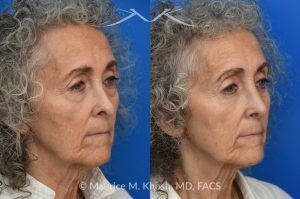 Photo of a patient before and after a procedure. Revision rhinoplasty with lower blepharoplasty 1 - This patient underwent revision rhinoplasty to improve nasal airflow, refine nasal tip symmetry, and achieve a natural, un-operated appearance. An open approach was used to place bilateral spreader grafts—double-layered on the left and single-layered on the right—fashioned from the septum. Ear cartilage was utilized as alar strut grafts to reshape and support the nasal tip, and septo-columellar sutures were used to improve columellar position. A cadaveric dermal graft was applied to the dorsum to create a smooth and natural contour. A lower eyelid blepharoplasty was performed simultaneously for added rejuvenation.