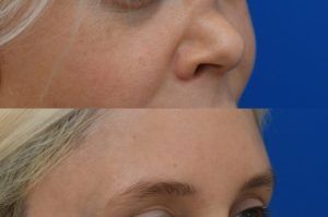 Photo of a patient before and after a procedure. Saddle Nose Repair with Autologous Rib Cartilage Graft 1  - Saddle nose deformity repair was performed to correct a collapsed nasal bridge, over-rotation of the nasal tip, and a deep crease across the lower bridge. The patient’s own rib cartilage was used to create two structural grafts—one along the dorsum and one supporting the tip (an L-strut configuration). A dermal graft was added to refine the dorsal contour and smooth the transition over the cartilage graft. Surgery effectively restored dorsal height, a straight and natural nasal profile, proper tip position and projection, and normal breathing function.  