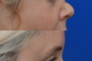 Photo of a patient before and after a procedure. Saddle Nose Repair with Autologous Rib Cartilage Graft 1  - Saddle nose deformity repair was performed to correct a collapsed nasal bridge, over-rotation of the nasal tip, and a deep crease across the lower bridge. The patient’s own rib cartilage was used to create two structural grafts—one along the dorsum and one supporting the tip (an L-strut configuration). A dermal graft was added to refine the dorsal contour and smooth the transition over the cartilage graft. Surgery effectively restored dorsal height, a straight and natural nasal profile, proper tip position and projection, and normal breathing function.  