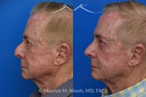 Photo of a patient before and after a procedure. Comprehensive Rhinoplasty and Brow Symmetry Restoration After Forehead Flap Reconstruction - This gentleman sought consultation for enhancement of the nose and increased symmetry in the position of his eyebrows. He had previously undergone excision of a large skin cancer from the right lower nose which was reconstructed with a left forehead flap (skin from the forehead was moved to the nose to cover the surgical defect). The flap resulted in a puffy appearing lower nose and exacerbated the droopy and deviated appearing nasal tip. Additionally, skin removal from the forehead elevated the position of the left eyebrow and resulted in a wide scar in the left upper forehead. 
During rhinoplasty surgery, the contour of the bridge and the tip of was improved and the puffy appearing flap was thinned. The brow lift surgery helped to elevate the right brow to match the position of the left eyebrow. The wide scar in the left forehead was eliminated. 