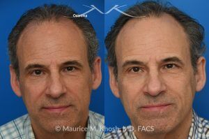 Photo of a patient before and after a procedure. Small Osteoma Removal via Hairline Incision - A relatively small osteoma in this patient was removed through a hairline incision, leaving no visible scar. 
