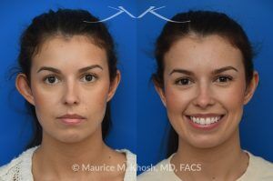 Photo of a patient before and after a procedure. Unilateral Otoplasty Under Local Anesthesia - This lovely patient requested unilateral otoplasty surgery on her right ear because it protruded excessively. Postoperatively, the ears show excellent symmetry. This case and nearly all of our otoplasty procedures are performed under local anesthesia in the office.