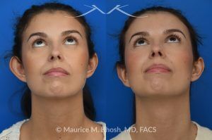 Photo of a patient before and after a procedure. Unilateral Otoplasty Under Local Anesthesia - This lovely patient requested unilateral otoplasty surgery on her right ear because it protruded excessively. Postoperatively, the ears show excellent symmetry. This case and nearly all of our otoplasty procedures are performed under local anesthesia in the office.