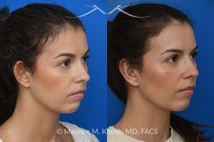Photo of a patient before and after a procedure. Unilateral Otoplasty Under Local Anesthesia - This lovely patient requested unilateral otoplasty surgery on her right ear because it protruded excessively. Postoperatively, the ears show excellent symmetry. This case and nearly all of our otoplasty procedures are performed under local anesthesia in the office.
