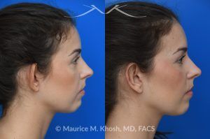 Photo of a patient before and after a procedure. Unilateral Otoplasty Under Local Anesthesia - This lovely patient requested unilateral otoplasty surgery on her right ear because it protruded excessively. Postoperatively, the ears show excellent symmetry. This case and nearly all of our otoplasty procedures are performed under local anesthesia in the office.