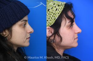 Photo of a patient before and after a procedure. Revision rhinoplasty - This young patient has a history of prior rhinoplasty resulting in a poorly defined, ptotic nasal tip with significant downward rotation on smiling. She also exhibited right-sided alar retraction, contributing to noticeable nostril asymmetry. Revision rhinoplasty was performed using an open approach to address all aesthetic and structural concerns.

A composite graft of skin and cartilage harvested from the ear was used to restore and support the right nostril position. A septal extension graft was placed to elevate and stabilize the ptotic nasal tip. Additionally, suture techniques were utilized to refine and narrow the nasal tip, achieving improved symmetry and definition.