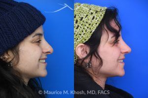 Photo of a patient before and after a procedure. Revision rhinoplasty - This young patient has a history of prior rhinoplasty resulting in a poorly defined, ptotic nasal tip with significant downward rotation on smiling. She also exhibited right-sided alar retraction, contributing to noticeable nostril asymmetry. Revision rhinoplasty was performed using an open approach to address all aesthetic and structural concerns.

A composite graft of skin and cartilage harvested from the ear was used to restore and support the right nostril position. A septal extension graft was placed to elevate and stabilize the ptotic nasal tip. Additionally, suture techniques were utilized to refine and narrow the nasal tip, achieving improved symmetry and definition.
