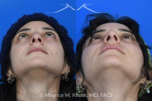 Photo of a patient before and after a procedure. Revision rhinoplasty - This young patient has a history of prior rhinoplasty resulting in a poorly defined, ptotic nasal tip with significant downward rotation on smiling. She also exhibited right-sided alar retraction, contributing to noticeable nostril asymmetry. Revision rhinoplasty was performed using an open approach to address all aesthetic and structural concerns.

A composite graft of skin and cartilage harvested from the ear was used to restore and support the right nostril position. A septal extension graft was placed to elevate and stabilize the ptotic nasal tip. Additionally, suture techniques were utilized to refine and narrow the nasal tip, achieving improved symmetry and definition.