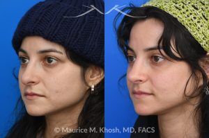 Photo of a patient before and after a procedure. Revision rhinoplasty - This young patient has a history of prior rhinoplasty resulting in a poorly defined, ptotic nasal tip with significant downward rotation on smiling. She also exhibited right-sided alar retraction, contributing to noticeable nostril asymmetry. Revision rhinoplasty was performed using an open approach to address all aesthetic and structural concerns.

A composite graft of skin and cartilage harvested from the ear was used to restore and support the right nostril position. A septal extension graft was placed to elevate and stabilize the ptotic nasal tip. Additionally, suture techniques were utilized to refine and narrow the nasal tip, achieving improved symmetry and definition.