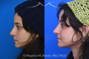 Photo of a patient before and after a procedure. Revision rhinoplasty - This young patient has a history of prior rhinoplasty resulting in a poorly defined, ptotic nasal tip with significant downward rotation on smiling. She also exhibited right-sided alar retraction, contributing to noticeable nostril asymmetry. Revision rhinoplasty was performed using an open approach to address all aesthetic and structural concerns.

A composite graft of skin and cartilage harvested from the ear was used to restore and support the right nostril position. A septal extension graft was placed to elevate and stabilize the ptotic nasal tip. Additionally, suture techniques were utilized to refine and narrow the nasal tip, achieving improved symmetry and definition.