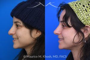 Photo of a patient before and after a procedure. Revision rhinoplasty - This young patient has a history of prior rhinoplasty resulting in a poorly defined, ptotic nasal tip with significant downward rotation on smiling. She also exhibited right-sided alar retraction, contributing to noticeable nostril asymmetry. Revision rhinoplasty was performed using an open approach to address all aesthetic and structural concerns.

A composite graft of skin and cartilage harvested from the ear was used to restore and support the right nostril position. A septal extension graft was placed to elevate and stabilize the ptotic nasal tip. Additionally, suture techniques were utilized to refine and narrow the nasal tip, achieving improved symmetry and definition.