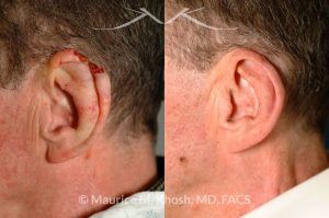 Photo of a patient before and after a procedure. Repair of helical rim with advancement flap - before and after results.