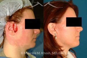 Photo of a patient before and after a procedure. Lateral cheek Mohs defect repaired with a facelift flap - before and after photos.