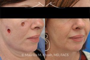 Photo of a patient before and after a procedure. Repair of cheek basal cell skin cancer defect after Mohs excision - before and after results.