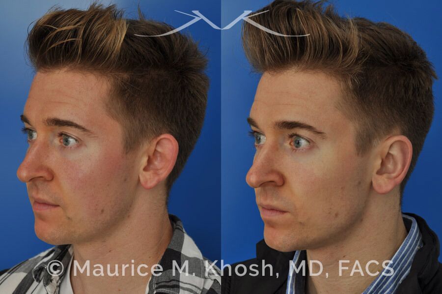Ear pinning to push back excessively projected ears and flatten ears