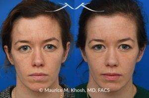 Photo of a patient before and after a procedure. Osteoma Removal via Hidden Hairline Incision - The bony hump in the right upper forehead (an osteoma) was successfully treated through a hairline incision with a perfectly hidden scar within the hairline.