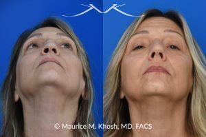 Photo of a patient before and after a procedure. Saddle Nose Reconstruction Using Autologous Rib Cartilage - Saddle nose nasal deformity due to large septum perforation and loss of bridge and tip support. The deformity was reconstructed utilizing the patient's own rib cartilage which was carved to recreate a natural nose that looks better and functions better.