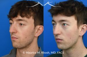 Photo of a patient before and after a procedure. Repair of Left Nasal Valve with Spreader Graft - This patient suffered a nasal fracture that resulted in the collapse of the left nasal valve. Reconstruction included a spreader graft on the right side and removal of the nasal hump. The surgery improved his breathing, enhanced nasal symmetry, and eliminated the bump on his nasal bridge.
