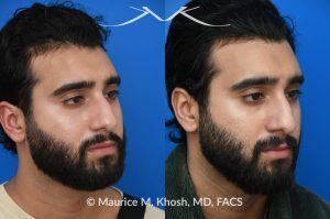 Photo of a patient before and after a procedure. Large Osteoma Removal Under Local Anesthesia - This large osteoma was successfully removed under local anesthesia using a power drill. The patient is ecstatic about his results. 
