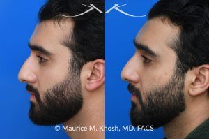 Photo of a patient before and after a procedure. Large Osteoma Removal Under Local Anesthesia - This large osteoma was successfully removed under local anesthesia using a power drill. The patient is ecstatic about his results. 