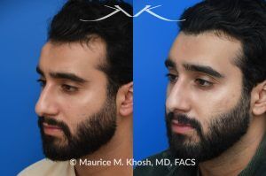 Photo of a patient before and after a procedure. Large Osteoma Removal Under Local Anesthesia - This large osteoma was successfully removed under local anesthesia using a power drill. The patient is ecstatic about his results. 