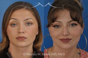 Photo of a patient before and after a procedure. Rhinoplasty to Correct Saddle Nose Deformity Caused by Autoimmune Condition - 27 year old with saddle nose collapse due to an autoimmune condition. She was bothered by the unnatural sag of the bridge of the nose, loss of nasal tip definition, and nasal obstruction. Her own rib cartilage was used during saddle nose rhinoplasty, to reconstruct the nose and restore breathing. The last two images show the computer simulation of surgical outcome (middle picture), as well as the final outcome (the picture on the right side). Patient is delighted with her results. 
