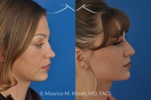 Photo of a patient before and after a procedure. Rhinoplasty to Correct Saddle Nose Deformity Caused by Autoimmune Condition - 27 year old with saddle nose collapse due to an autoimmune condition. She was bothered by the unnatural sag of the bridge of the nose, loss of nasal tip definition, and nasal obstruction. Her own rib cartilage was used during saddle nose rhinoplasty, to reconstruct the nose and restore breathing. The last two images show the computer simulation of surgical outcome (middle picture), as well as the final outcome (the picture on the right side). Patient is delighted with her results. 