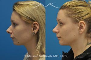 Photo of a patient before and after a procedure. Rhinoplasty and Chin Implant - before-and-after composite photo.