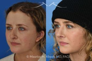 Photo of a patient before and after a procedure. Rhinoplasty to Correct Nasal Hump and Drooping Tip - This amazing 22 year-old was bothered by the droopiness of the tip of her nose and the large nasal hump. We used the open approach to perform septoplasty, dorsal reduction, caudal septum shortening, cephalic trimming, and alar strut grafts. She is delighted with the improved breathing, and loves the new shape of her tip and the bridge of her nose. 
