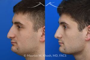 Photo of a patient before and after a procedure. Rhinoplasty for Nasal Obstruction and Aesthetic Correction - This patient's main complaint was bilateral severe nasal obstruction. His secondary concern was the dorsal hump and droopy nasal tip. We used an open rhinoplasty approach to straighten his deviated septum, lower the dorsal hump and place bilateral spreader grafts to widen the internal nasal valve to enhance his breathing. The nasal tip was reduced in size and rotated to achieve the desired tip position.