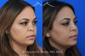 Photo of a patient before and after a procedure. Saddle Nose Repair with Rib Cartilage and Alloderm Graft - This lovely patient had developed saddle collapse of the nose, over-rotation of the nasal tip, and severe nasal obstruction, associated with a septum perforation. In the operating room, a segment of her rib was used to create cartilage grafts to augment the dorsum, and support the nasal tip. A shield graft was fashioned to enhance her nasal tip. Alloderm graft was applied above the dorsal cartilage graft, under the skin. Internal nasal scar tissue was released to further improve breathing. 