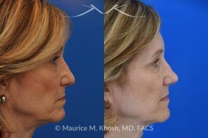 Photo of a patient before and after a procedure. Secondary Repair of Nostril Retraction After Mohs Surgery - This lovely 60 year-old had undergone repair of Mohs cancer removal from the left lower nose, by another surgeon. Unfortunately, this resulted in severe retraction of the left nostril and an unacceptable nasal deformity. 
Rhinoplasty to address nostril retraction was performed in Manhattan. Cartilage graft to the left nostril and composite graft (combination of skin and cartilage graft) to the inside edge of the nostril, helped to restore normality to the nose. The post op pictures are 6 months following her rhinoplasty.