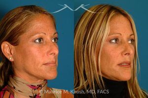 Photo of a patient before and after a procedure. Rhinoplasty for Tip & Dorsum - This patient was interested in addressing the hump on her nose and reducing the columellar show (hanging columella). Surgery was performed via the closed rhinoplasty approach.