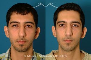Photo of a patient before and after a procedure. Rhinoplasty and Chin Implant - before-and-after composite photo.