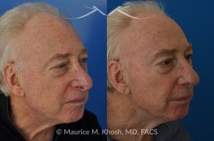 Photo of a patient before and after a procedure. Revision Rhinoplasty with Nasal Vestibular Stenosis Repair - This 73 year old had previously undergone rhinoplasty in his 20's. The surgery had left his nose deformed and severely obstructed. Revision rhinoplasty and repair of nasal vestibular stenosis was accomplished with use of cadaver rib cartilage. Revision surgery helped to restore a natural shape to the nose, and alleviate his breathing issues. He is delighted with the surgical results.