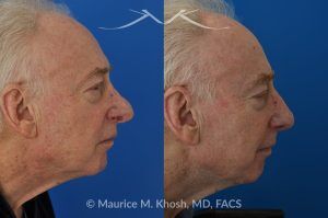 Photo of a patient before and after a procedure. Revision Rhinoplasty with Nasal Vestibular Stenosis Repair - This 73 year old had previously undergone rhinoplasty in his 20's. The surgery had left his nose deformed and severely obstructed. Revision rhinoplasty and repair of nasal vestibular stenosis was accomplished with use of cadaver rib cartilage. Revision surgery helped to restore a natural shape to the nose, and alleviate his breathing issues. He is delighted with the surgical results.
