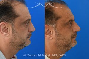 Photo of a patient before and after a procedure. Revision Rhinoplasty and Nasal Valve Reconstruction - This 53 year old had originally undergone rhinoplasty over 30 years ago. Surgery had left his nose pinched, depressed, short, and deformed. He had severe nasal obstruction. Revision rhinoplasty was performed with the use of his own rib cartilage to restore a normal shape to his nose and improve his breathing.