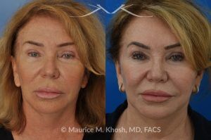 Photo of a patient before and after a procedure. Upper Lip Rejuvenation Surgery - This 65 year old desired a rejuvenated upper lip. She noted the upper lip to be excessively long, covering her upper teeth and giving her a tired and aged appearance. Lip fillers only exacerbated the problem. The post op photos on the right side show her results at 6 months after surgery.