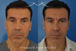 Photo of a patient before and after a procedure. Repair of Nasal Valve Obstruction with Revision Rhinoplasty - This gentleman had previously undergone two rhinoplasty operations over 15 years ago. His nasal tip was pinched and obstructing his breathing, Cadaver rib cartilage was used to strengthen and support his external nasal valve. The nasal tip was slightly elevated.