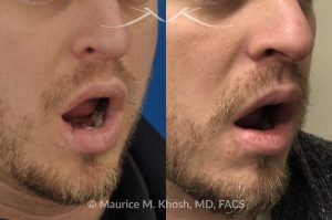 Photo of a patient before and after a procedure. Lower Lip Scar Revision After Dog Bite Injury - This gentleman sustained a dog bite injury resulting in loss of part of his lower lip. The injured site was repaired in the emergency room. He then visited us for improvement of a depressed and notched appearing lip scar. The right side picture shows the results of the scar revision for his lip, resulting in a minimally noticeable vertical scar of the lip. 