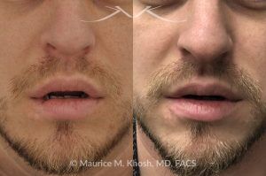 Photo of a patient before and after a procedure. Lower Lip Scar Revision After Dog Bite Injury - This gentleman sustained a dog bite injury resulting in loss of part of his lower lip. The injured site was repaired in the emergency room. He then visited us for improvement of a depressed and notched appearing lip scar. The right side picture shows the results of the scar revision for his lip, resulting in a minimally noticeable vertical scar of the lip. 