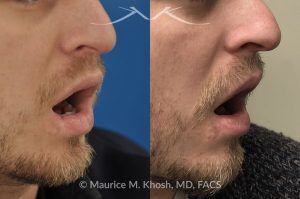 Photo of a patient before and after a procedure. Lower Lip Scar Revision After Dog Bite Injury - This gentleman sustained a dog bite injury resulting in loss of part of his lower lip. The injured site was repaired in the emergency room. He then visited us for improvement of a depressed and notched appearing lip scar. The right side picture shows the results of the scar revision for his lip, resulting in a minimally noticeable vertical scar of the lip. 