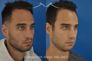 Photo of a patient before and after a procedure. Left-Sided Nasal Valve Repair with Spreader Graft - pre- and post-operative.