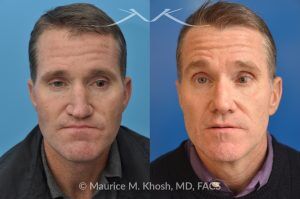 Photo of a patient before and after a procedure. Nasal Valve Repair with Rib Cartilage Graft - pre- and post-operative.