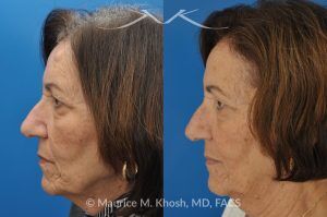 Photo of a patient before and after a procedure. Osteoma Removal from Forehead Under Local Anesthesia - 68 year old lady interested in osteoma removal in Manhattan. Problem: Hard, round, raised mass underneath the forehead skin. Procedure: Osteoma removal as an office procedure, under local anesthesia.