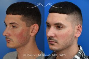 Photo of a patient before and after a procedure. Otoplasty to Correct Prominent Ears and Reduce Left Ear Size - This 26 year-old requested consultation regarding earpinnig and reducing the size of the left ear. He found both ears to be sticking out too far, and noted the left ear to be larger than the right side. Otopalsty was performed under local anesthesia in our Manhattan office. Both ears were pushed closer to the scalp. The left ear was shortened.