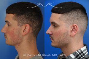 Photo of a patient before and after a procedure. Otoplasty to Correct Prominent Ears and Reduce Left Ear Size - This 26 year-old requested consultation regarding earpinnig and reducing the size of the left ear. He found both ears to be sticking out too far, and noted the left ear to be larger than the right side. Otopalsty was performed under local anesthesia in our Manhattan office. Both ears were pushed closer to the scalp. The left ear was shortened.